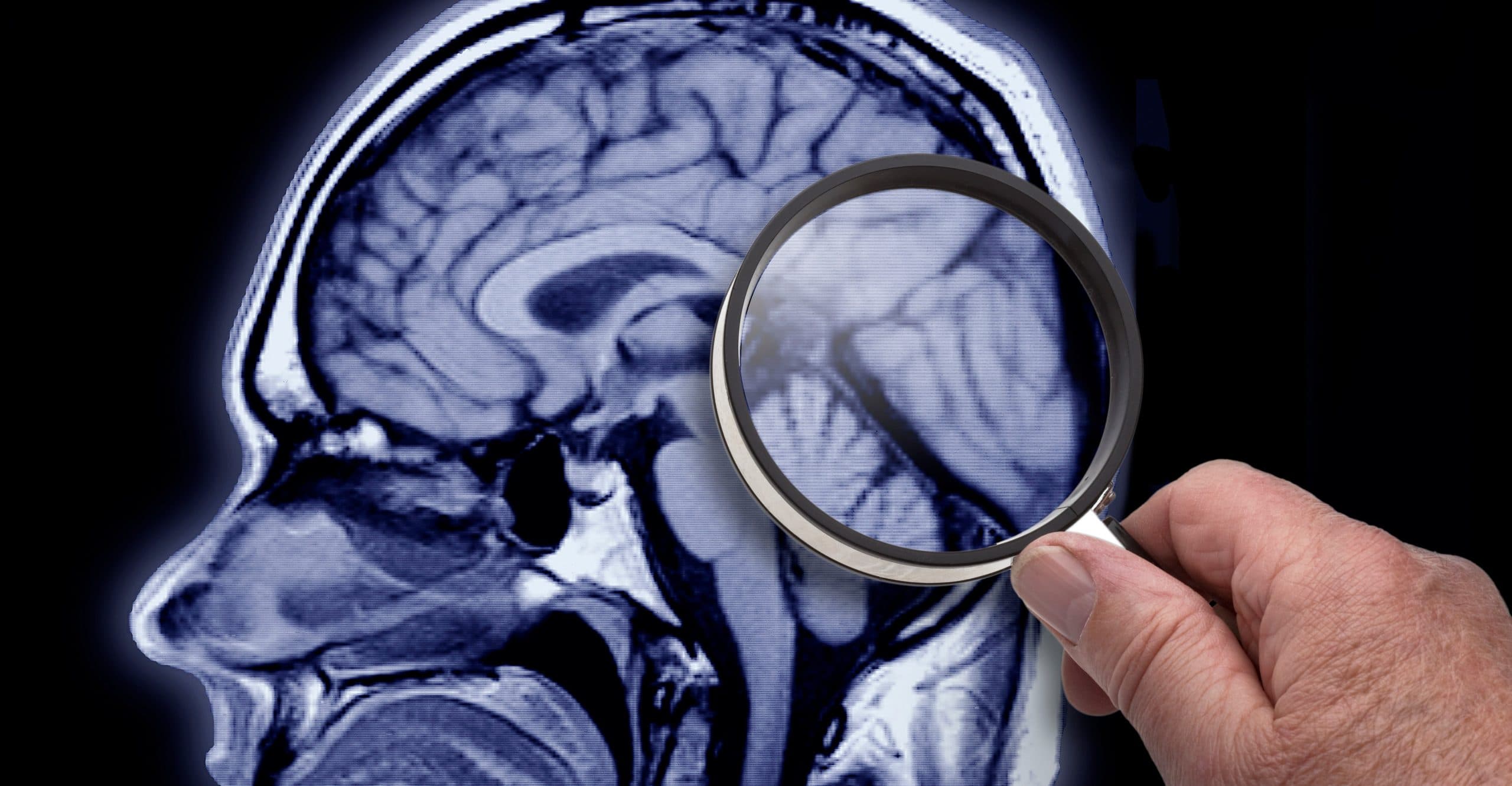 Alzheimer’s disease continues to elude a breakthrough treatment. What are we missing?