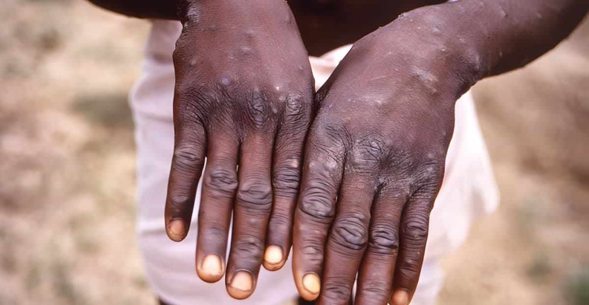 Africa declares monkeypox a continental emergency. Will it change anything?